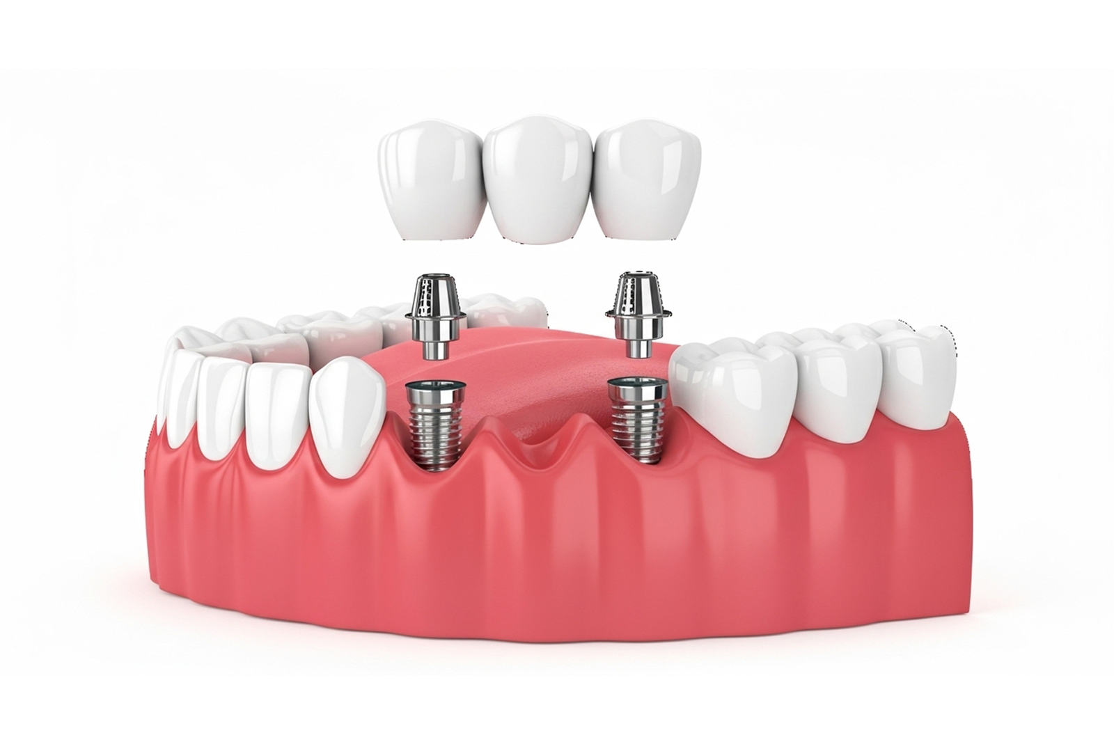 Dental Implants